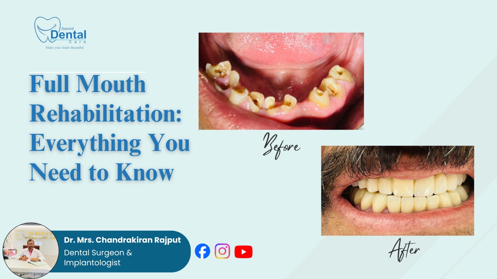 Full Mouth Rehabilitation: Everything You Need to Know