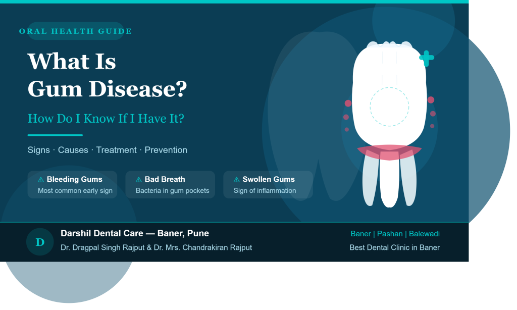 Gum Disease Signs & Treatment | Darshil Dental Care Baner Pune