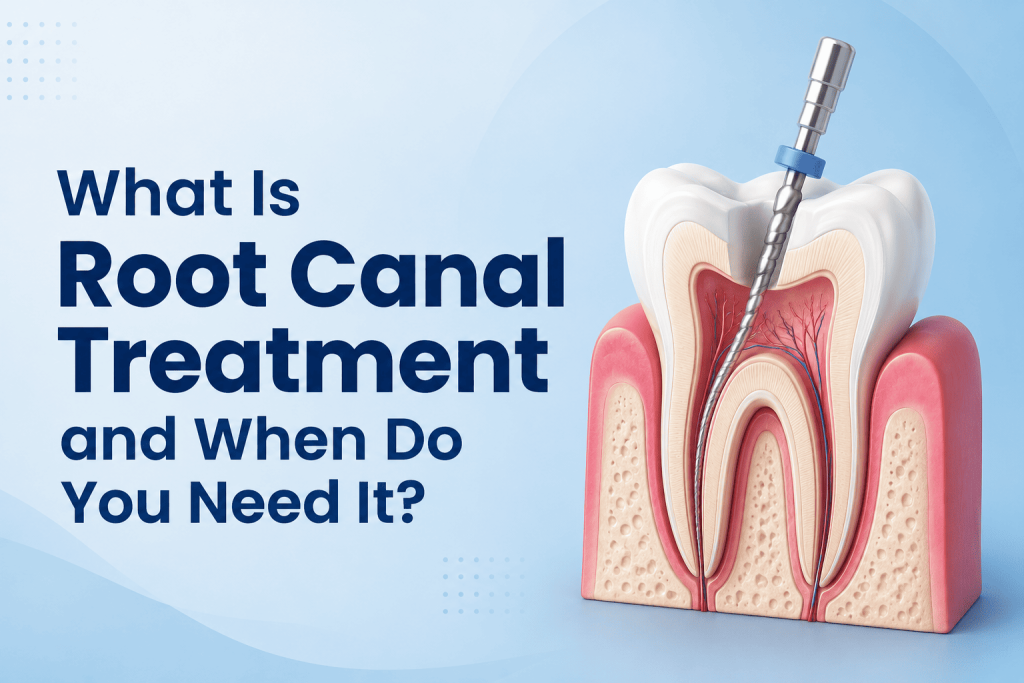 What Is Root Canal Treatment and When Do You Need It?